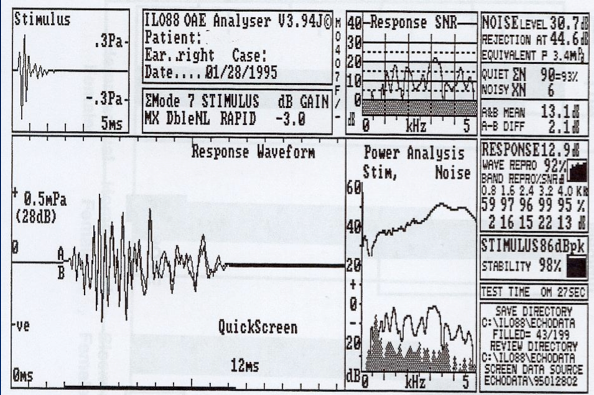 Combined Oae And Aabr Approach For Newborn Hearing Screening James W